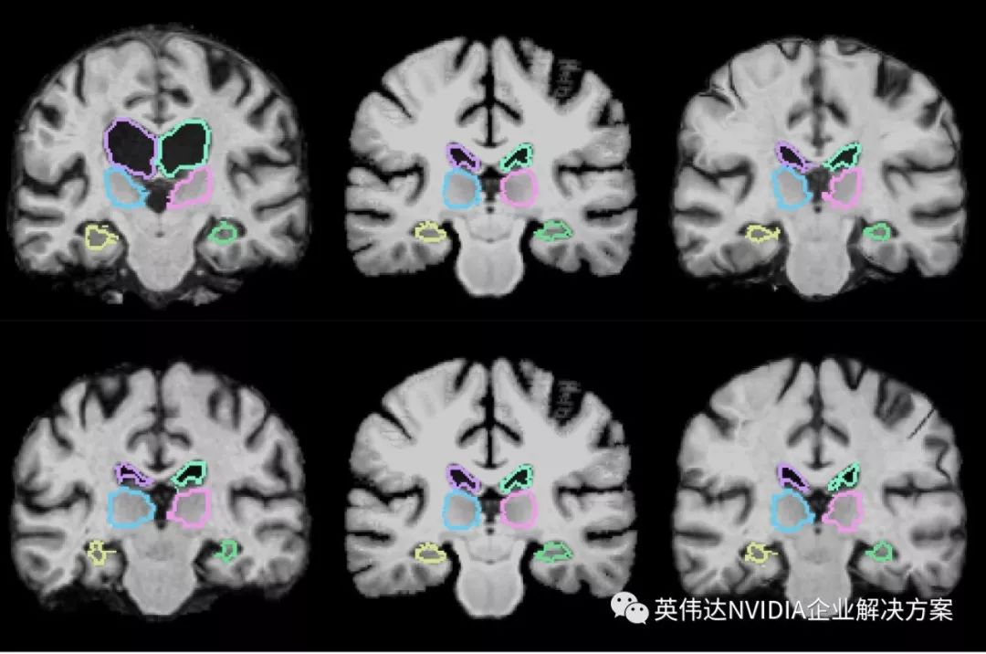 肿瘤跟踪：神经网络如何极速对比脑部MRI图像