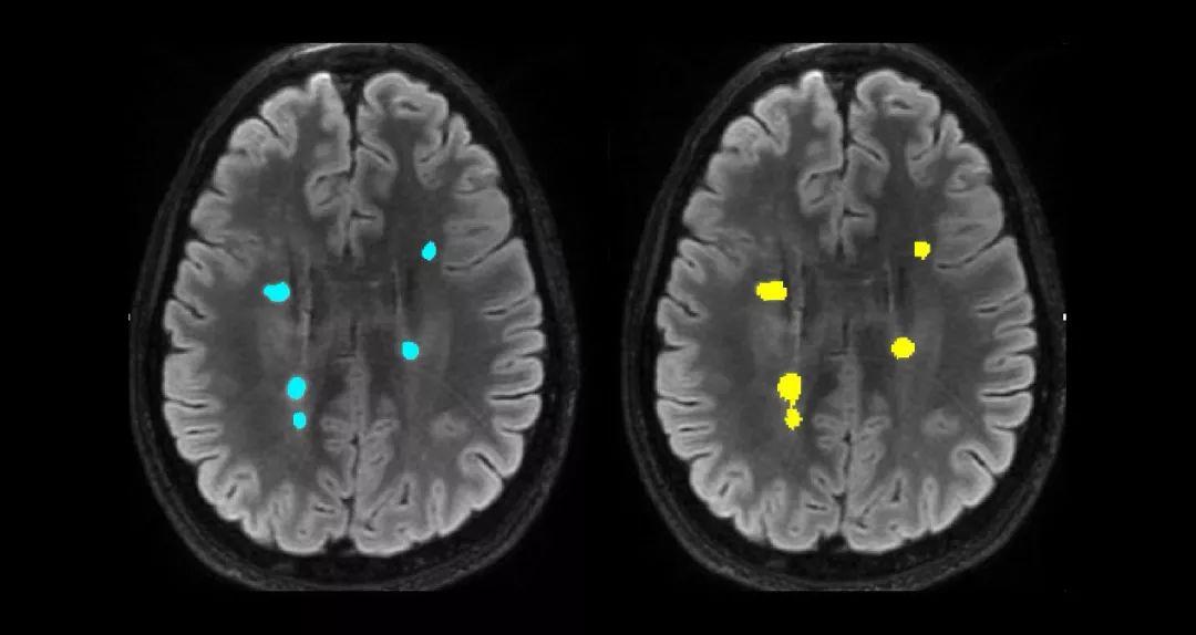 AI 心智结构：神经网络助力提升脑部扫描分析速度和一致性