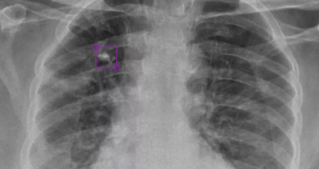 NVIDIA 助力初创公司通过 X 射线诊断肺结核