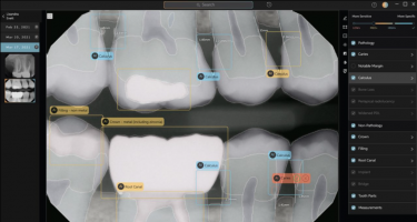 牙科 AI 技术帮助医生避免影像诊断中的疏漏
